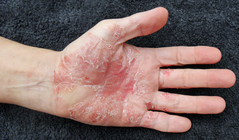 Treatments for Psoriasis: How to Manage This Chronic Skin Disorder