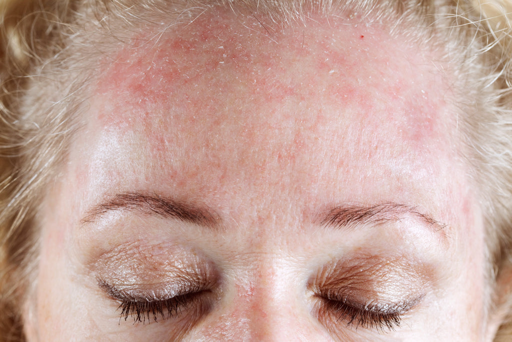 Scaly Scalp? You May Have Seborrheic Dermatitis!