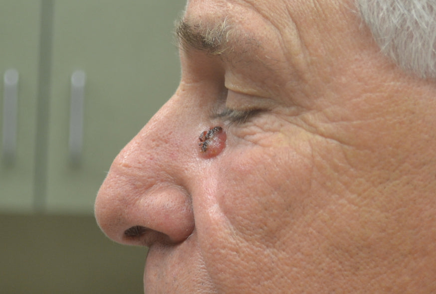 Everything You Need to Know About Skin Cancer