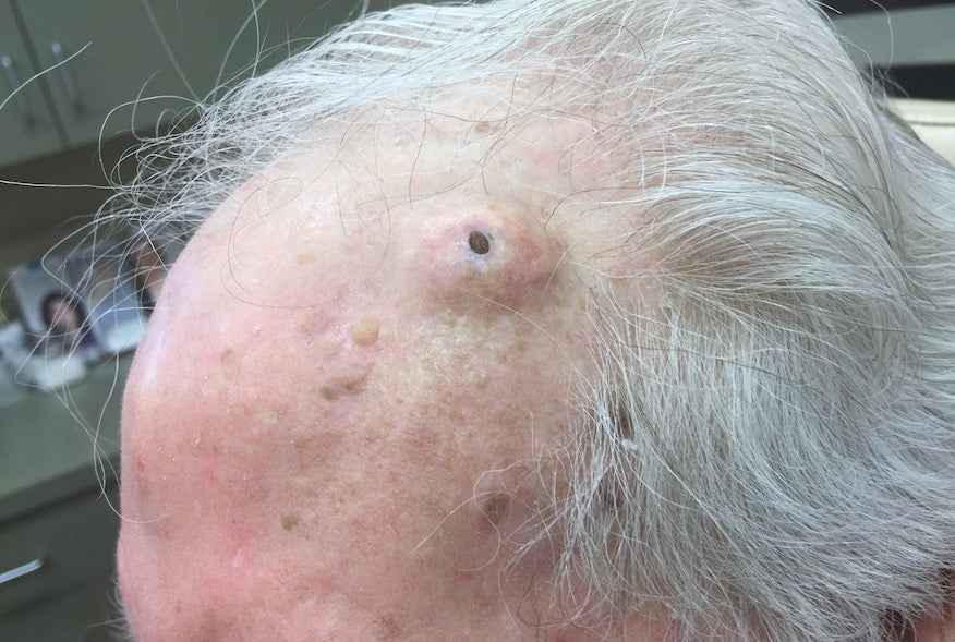 Gigantic Blackheads: Dilated Pore of Winer Explained!