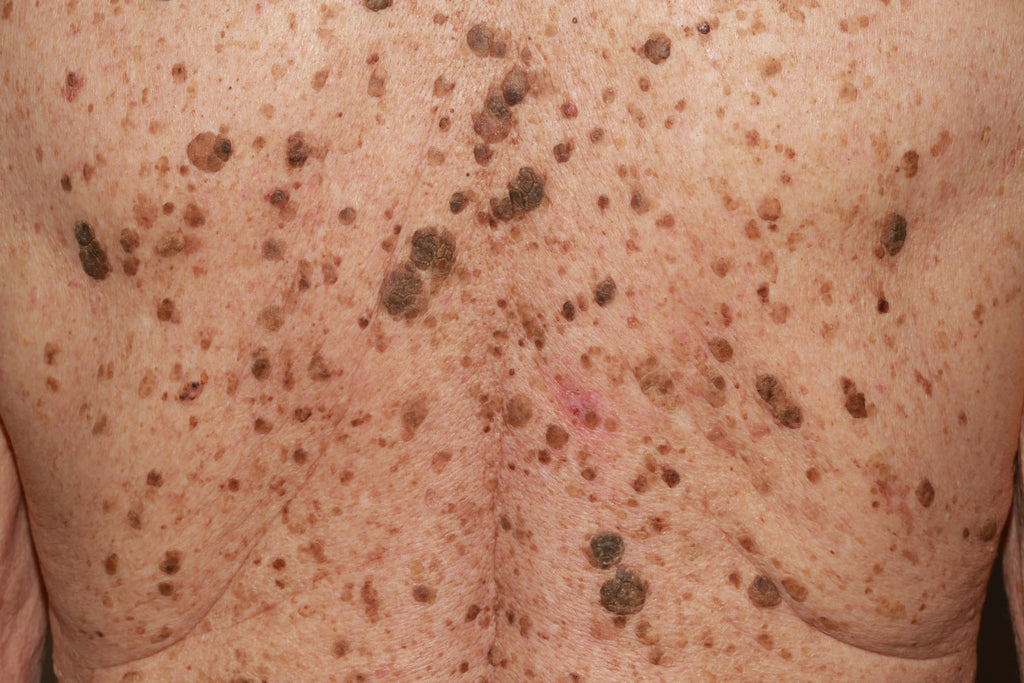 Got Mystery, Wart-Like Growths? They May Be Seborrheic Keratoses!