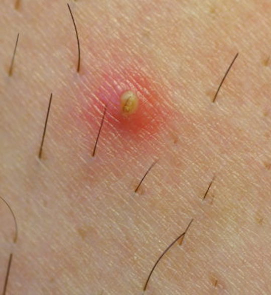 How To Treat & Prevent Ingrown Hairs