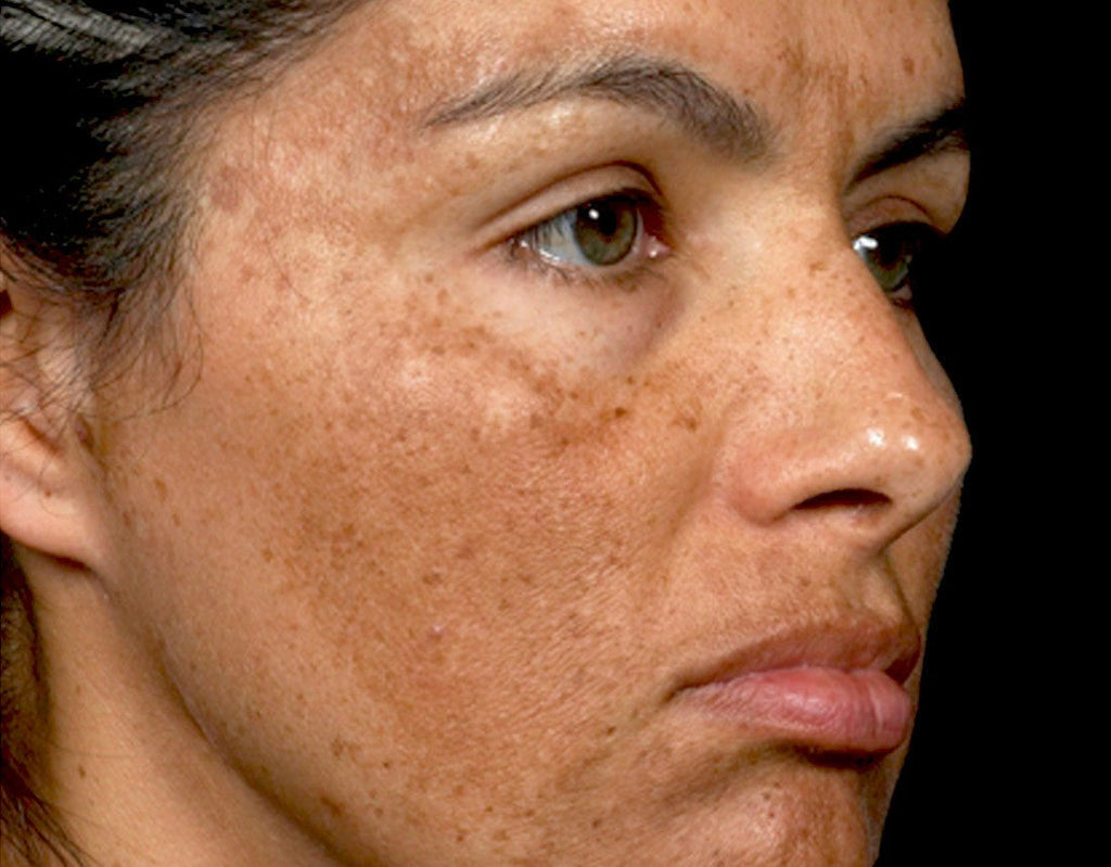 Your Guide to Melasma: How To Treat Tricky Dark Spots