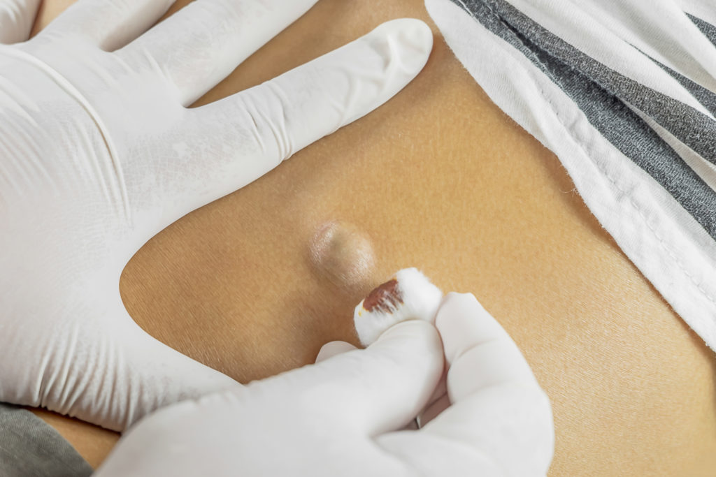 Difference Between A Pilonidal or Sebaceous Cyst