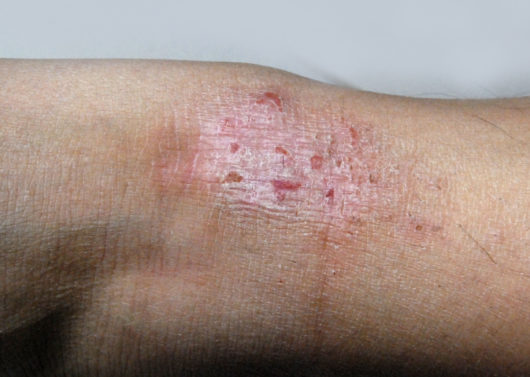 Why Is My Skin So Dry, Itchy & Rough? The Low Down on Eczema - Dr