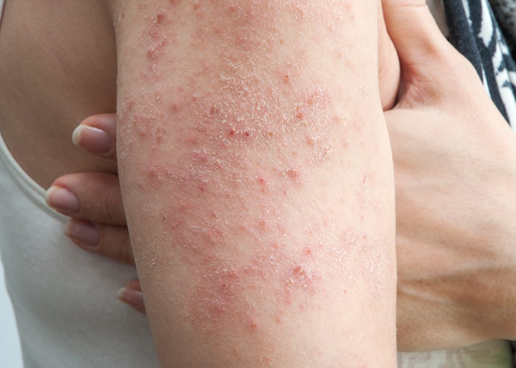 why-is-my-skin-so-dry-itchy-rough-the-low-down-on-eczema-dr