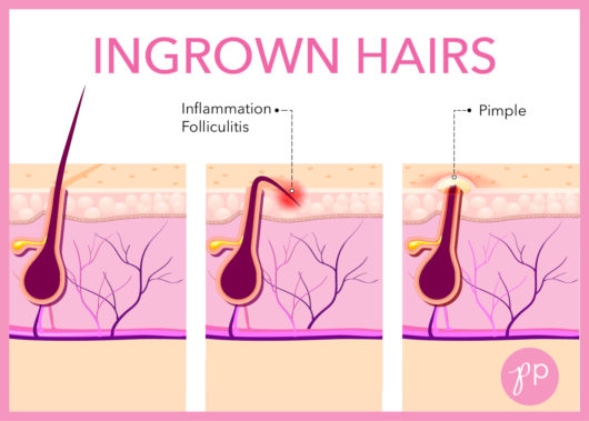 How To Treat Prevent Ingrown Hairs Dr Pimple Popper